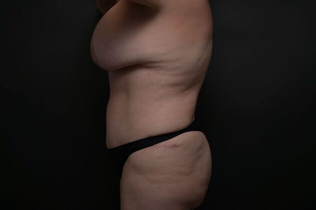 Tummy Tuck with LipoContouring: Case 11 - After