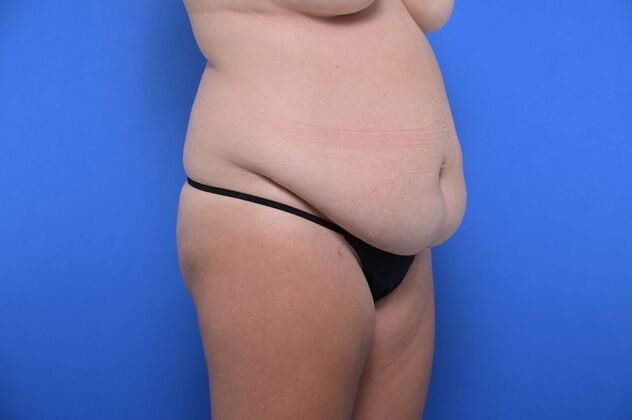 Tummy Tuck with LipoContouring: Case 12 - Before