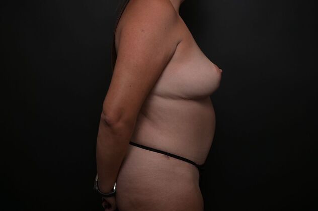 Tummy Tuck with LipoContouring: Case 12 - After