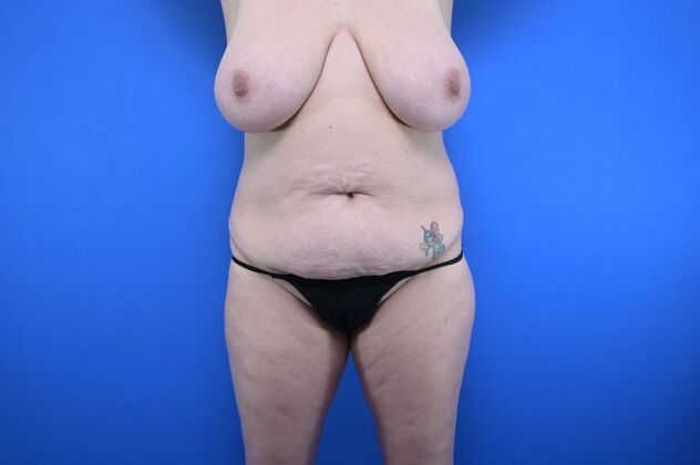 Tummy Tuck with LipoContouring: Case 13 - Before