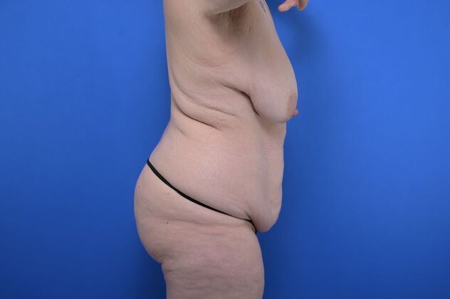 Massive Weight Loss patients: Case 2 - Before