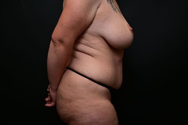 Massive Weight Loss patients: Case 2 - After