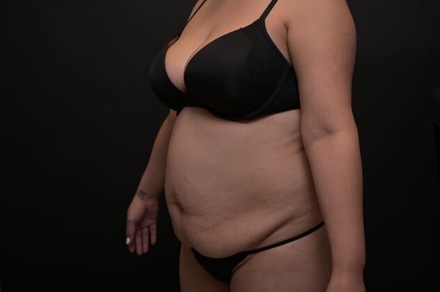 Tummy Tuck with LipoContouring: Case 14 - Before