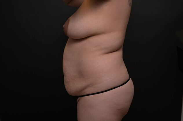 Tummy Tuck with LipoContouring: Case 14 - Before
