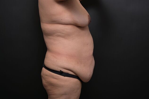 Tummy Tuck with LipoContouring: Case 15 - Before