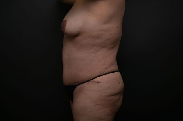 Tummy Tuck with LipoContouring: Case 15 - After