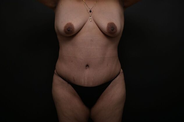 Tummy Tuck with LipoContouring: Case 15 - After