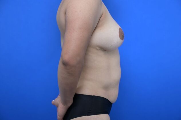 Tummy Tuck with LipoContouring: Case 17 - Before