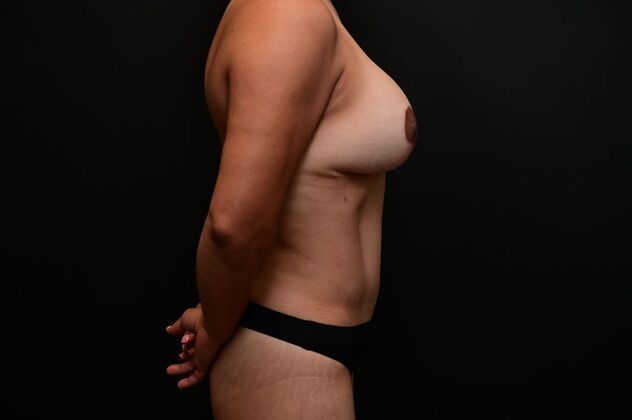 Tummy Tuck with LipoContouring: Case 17 - After
