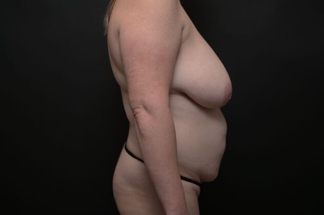 Tummy Tuck with LipoContouring: Case 18 - Before