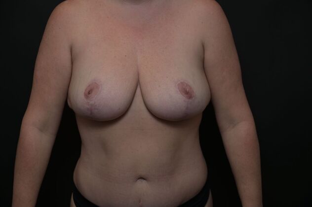 Tummy Tuck with LipoContouring Case 18 - After