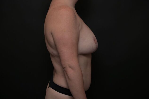 Tummy Tuck with LipoContouring: Case 18 - After
