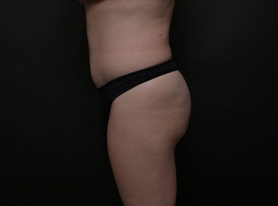 Tummy Tuck with LipoContouring: Case 18 - After