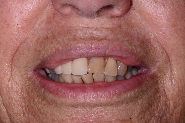 All-on-4 Dental Implants Case 1 - Before