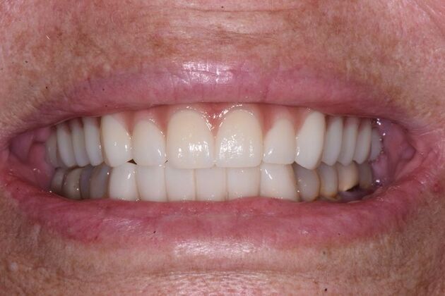All-on-4 Dental Implants Cases