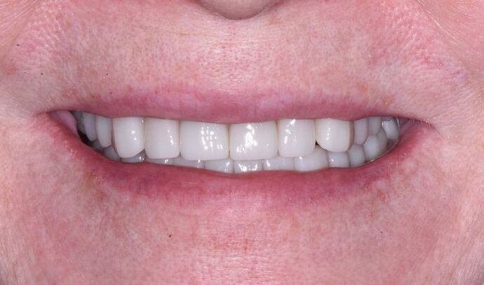 Full Mouth Rehabilitation with Dental Implants Case 7 - After