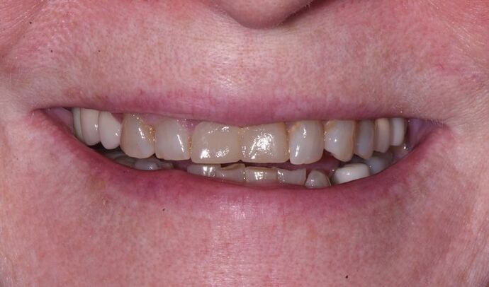 Full Mouth Rehabilitation with Dental Implants Case 7 - Before