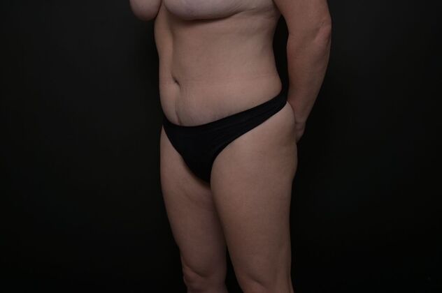 Tummy Tuck with LipoContouring: Case 18 - After
