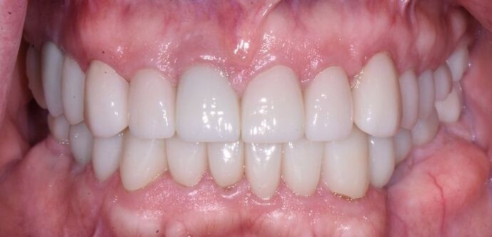 Full Mouth Rehabilitation with Dental Implants: Case 7 - After