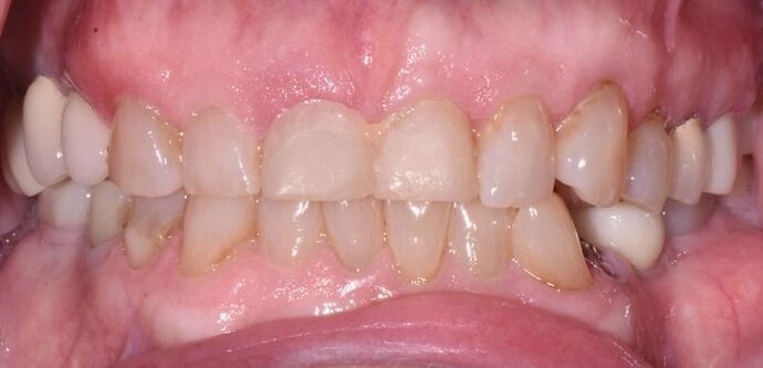 Full Mouth Rehabilitation with Dental Implants: Case 7 - Before