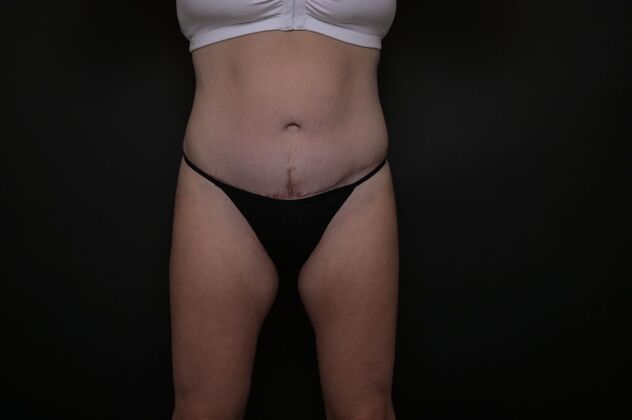 Tummy Tuck with LipoContouring: Case 18 - After
