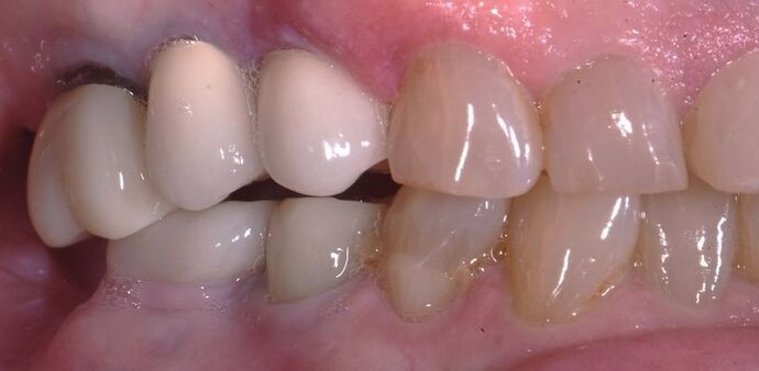 Full Mouth Rehabilitation with Dental Implants: Case 7 - Before