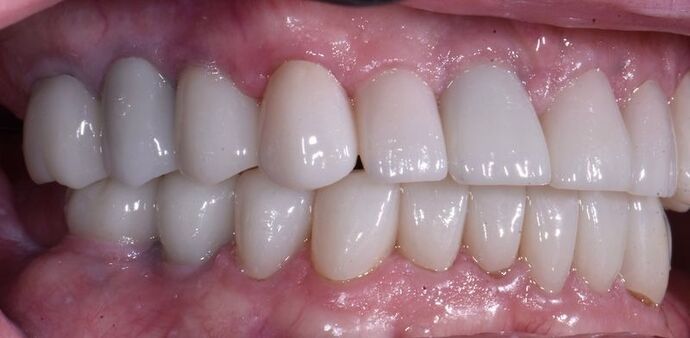 Full Mouth Rehabilitation with Dental Implants: Case 7 - After