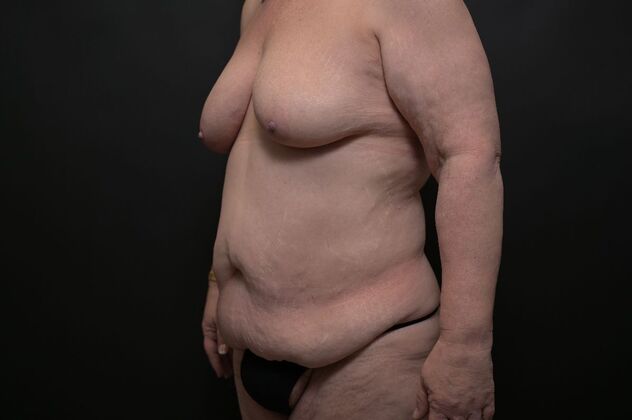 Tummy Tuck with LipoContouring: Case 19 - Before