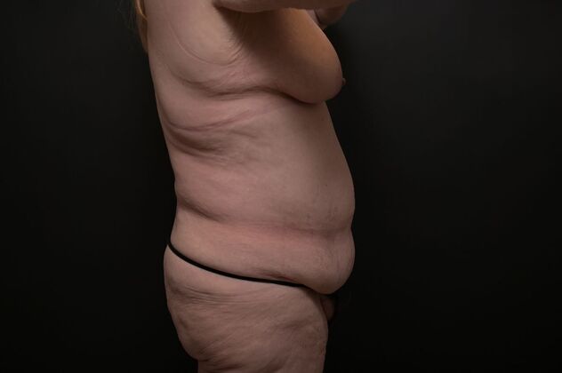 Tummy Tuck with LipoContouring: Case 19 - Before
