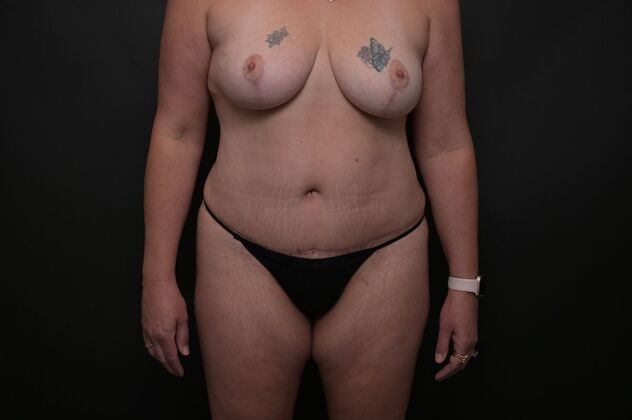 Tummy Tuck with LipoContouring Case 20 - After
