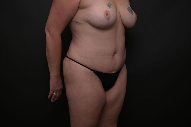 Tummy Tuck with LipoContouring: Case 20 - After