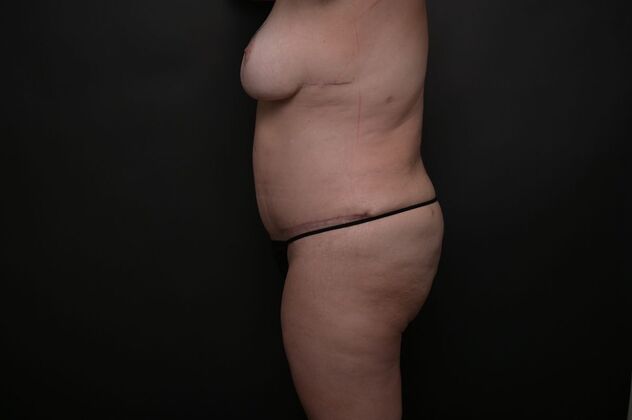 Tummy Tuck with LipoContouring: Case 20 - After