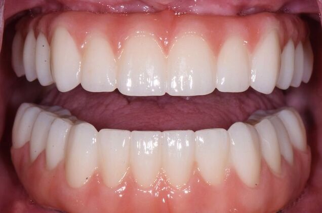All-on-4 Dental Implants Case 2 - After