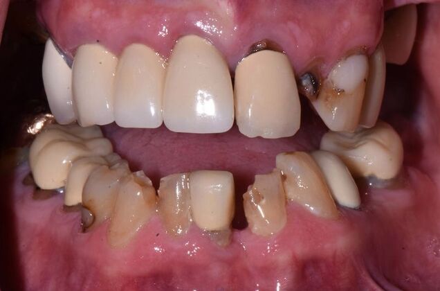 All-on-4 Dental Implants Case 2 - Before