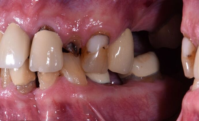 All-on-4 Dental Implants: Case 2 - Before