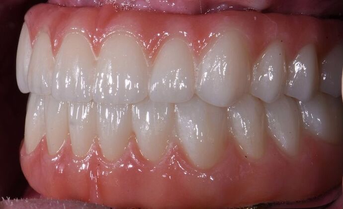 All-on-4 Dental Implants: Case 2 - After