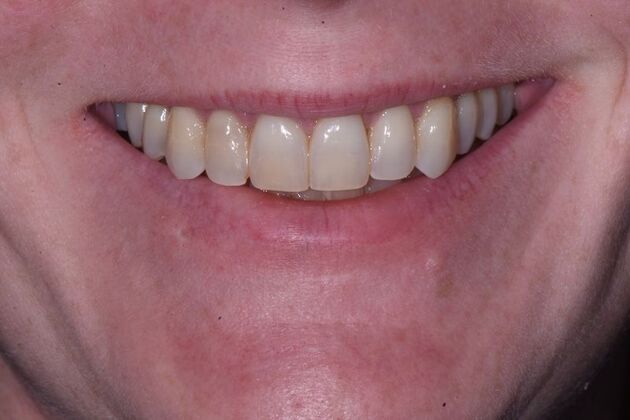 Whitening Case 11 - Before