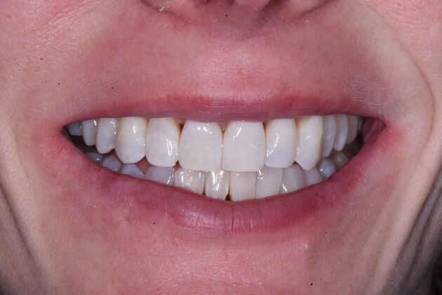 Whitening Case 11 - After