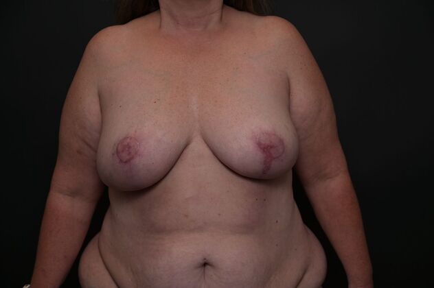 Breast Reduction Case 23 - After