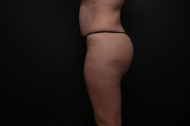 Tummy Tuck with LipoContouring: Case 17 - After