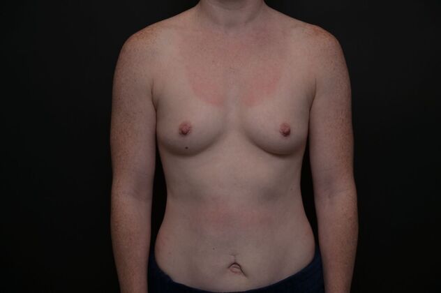 Breast Augmentation Case 17 - Before