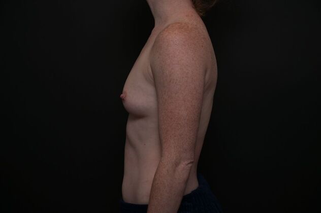Breast Augmentation: Case 17 - Before