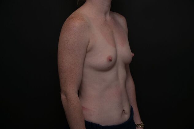 Breast Augmentation: Case 17 - Before