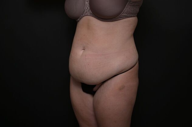 Tummy Tuck with LipoContouring: Case 21 - Before