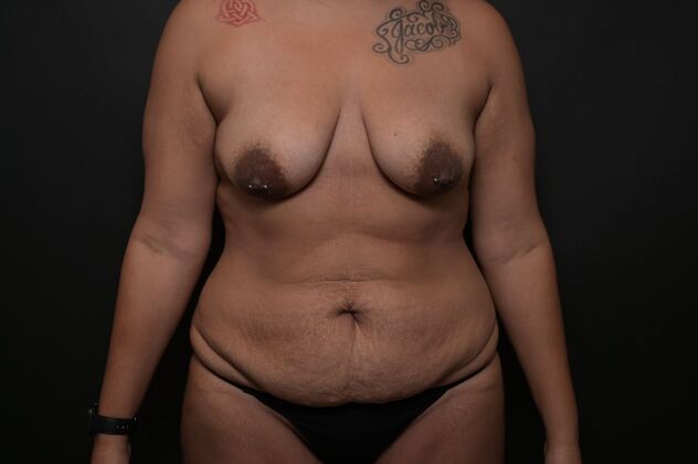 Tummy Tuck with LipoContouring Case 22 - Before