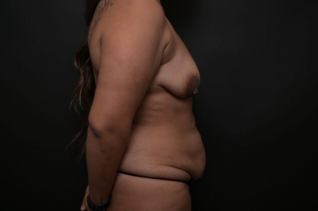 Tummy Tuck with LipoContouring: Case 22 - Before