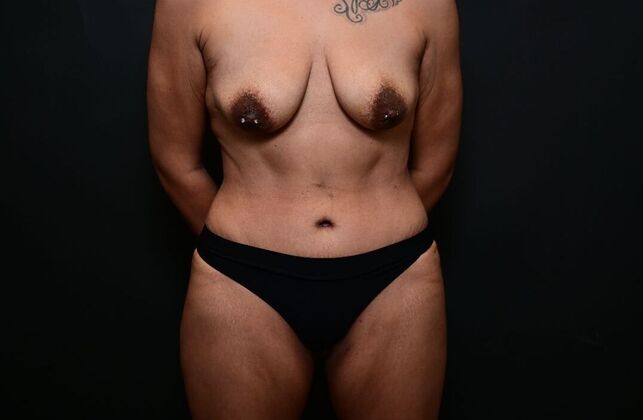 Tummy Tuck with LipoContouring Case 22 - After