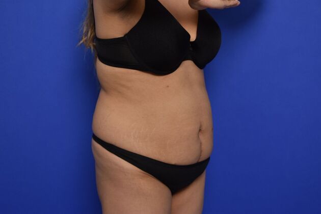 Tummy Tuck with LipoContouring: Case 25 - Before