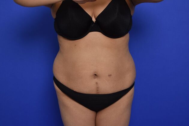 Tummy Tuck with LipoContouring Case 25 - Before