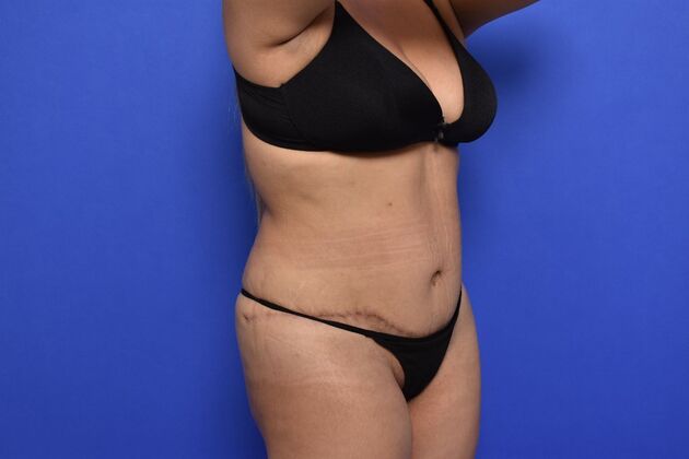 Tummy Tuck with LipoContouring: Case 25 - After